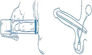 պոմպի սկզբունքը առնանդամի ընդլայնման համար